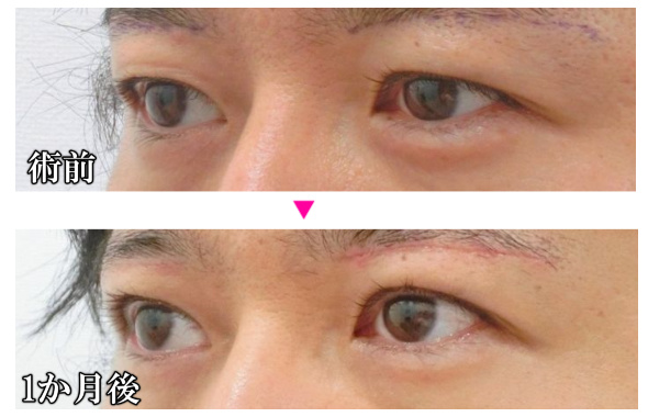 眉下リフト2 二重の幅を変えずに瞼の重みを取り除きパッチリする方法 医療脱毛専業の美容皮膚科医のブログ